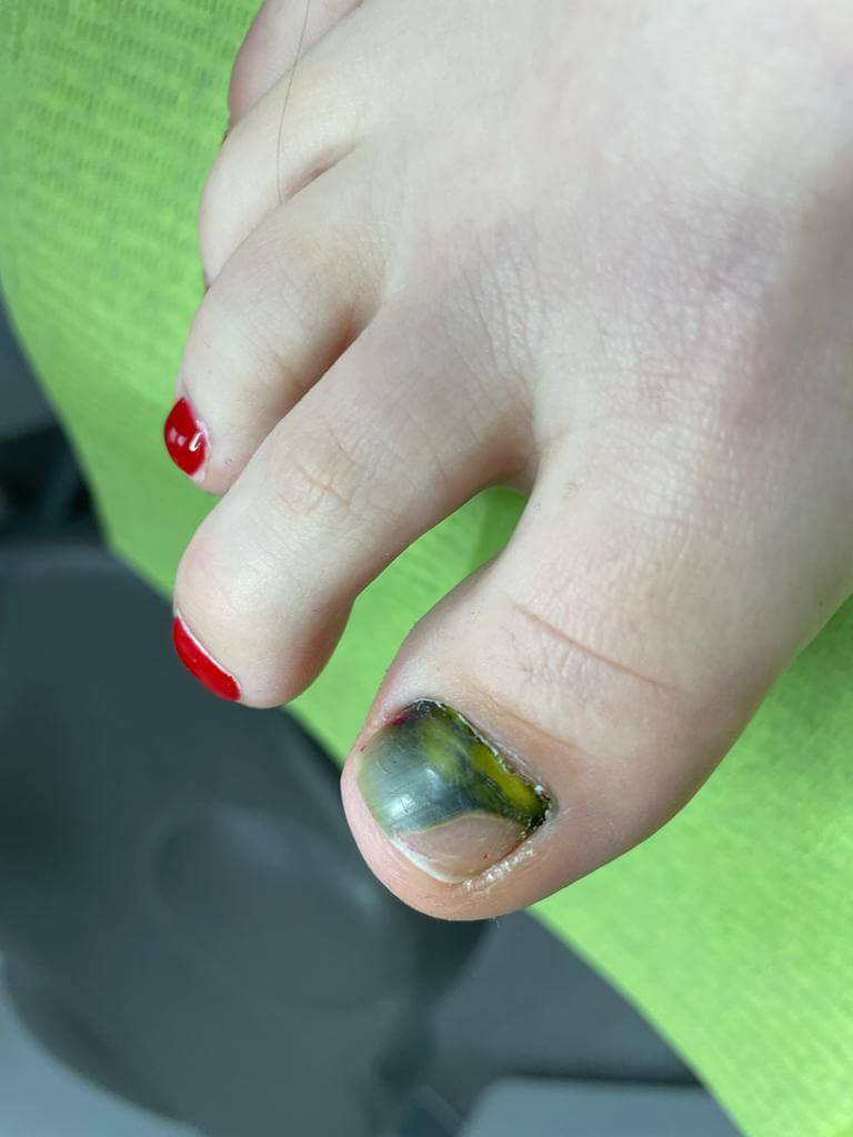 terapia paAeczki ropy bAAkitnej 1 wizyta